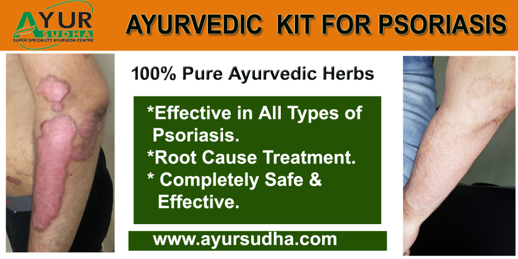 Best ayurvedic Psoriasis Treatment