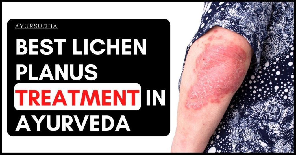 best lichen planus treatment in ayurveda