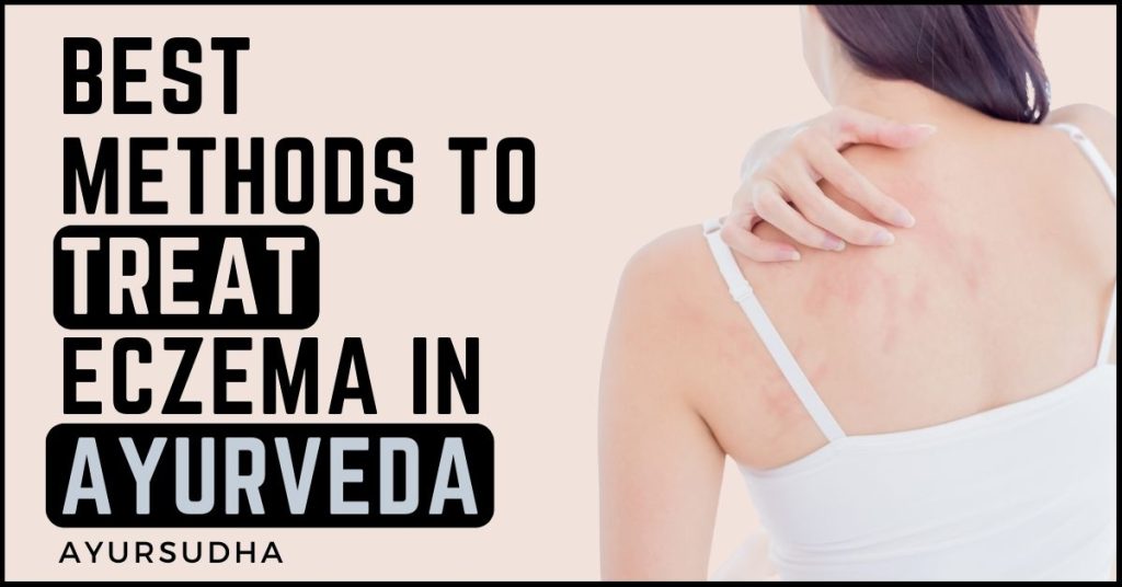 Best Methods to Treat Eczema in Ayurveda