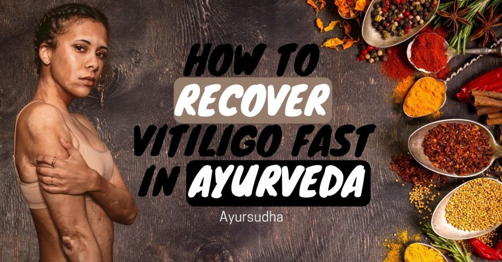 How to recover Vitiligo fast in Ayurveda? 