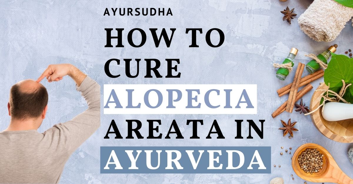how to cure alopecia areata in ayurveda