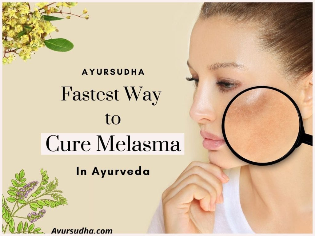 WHAT IS THE FASTEST WAY TO CURE MELASMA IN AYURVEDA