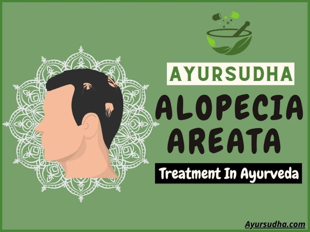 alopecia areata treatment in ayurveda