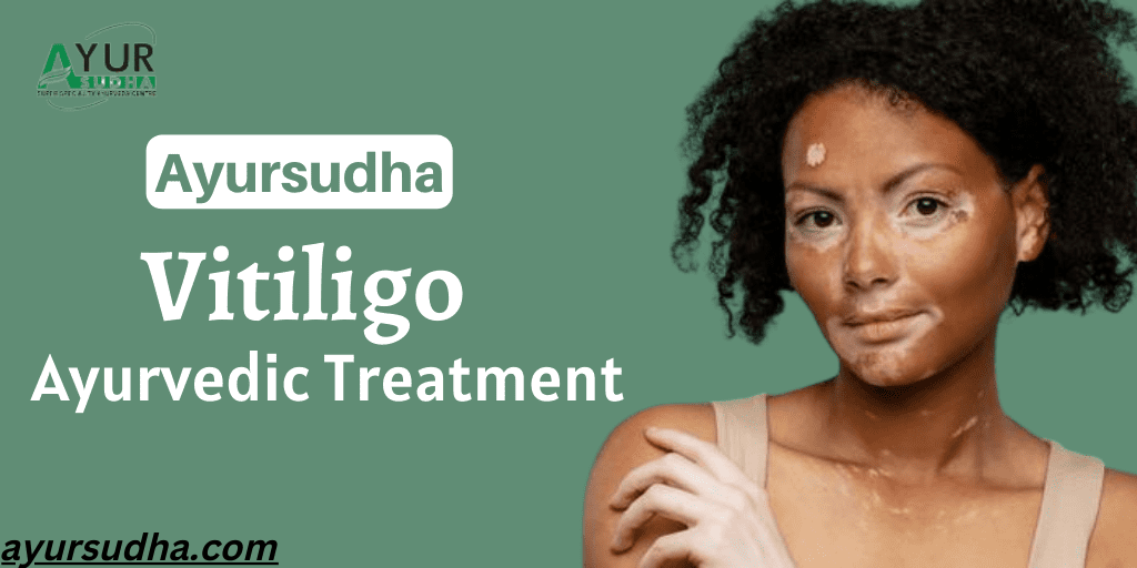 Best Vitiligo Treatment